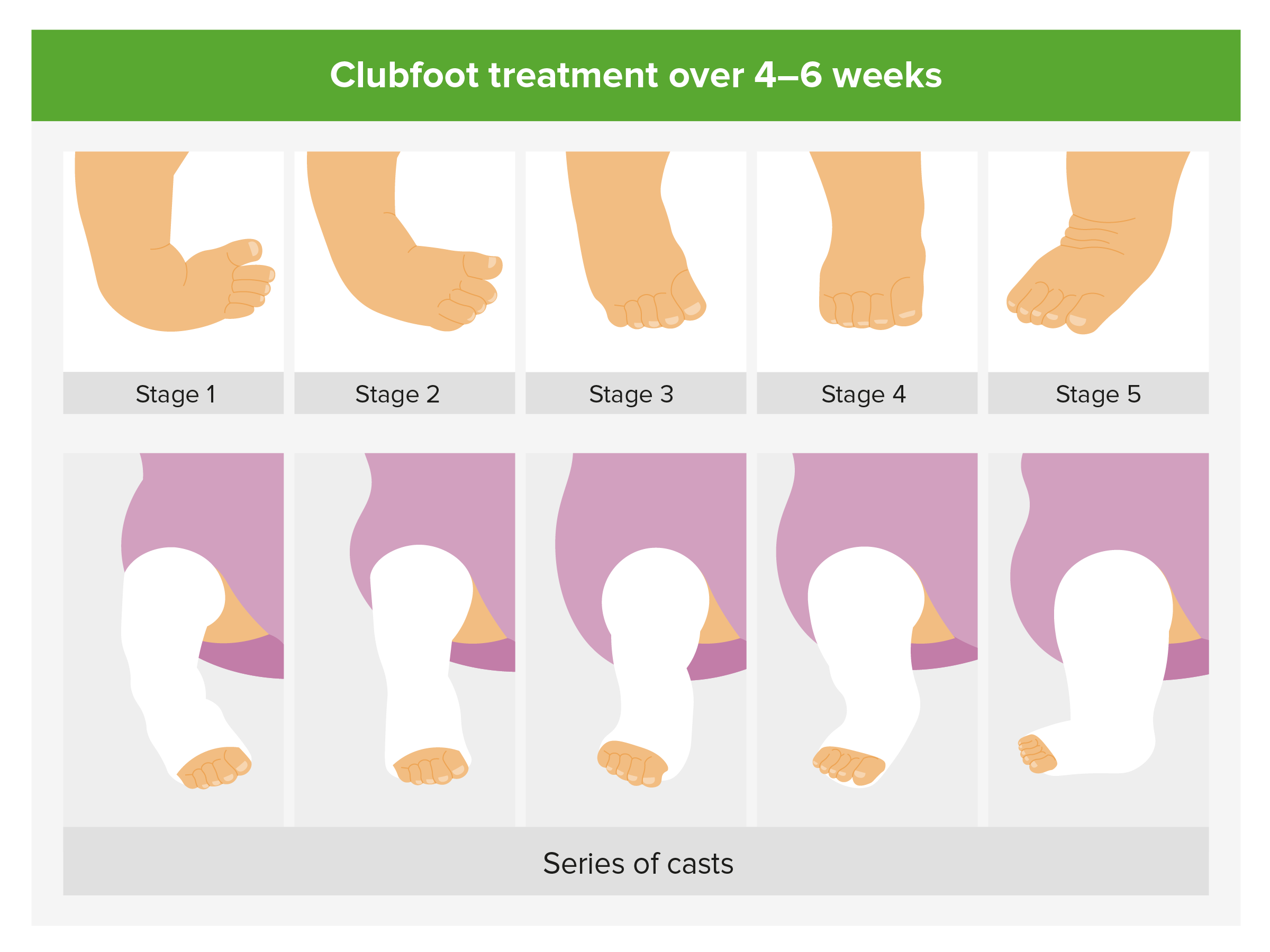 Treatment Options for Clubfoot: What You Need to Know