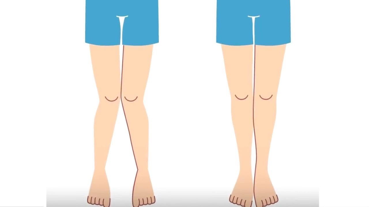 Understanding Knock Knees: Causes and Risk Factors