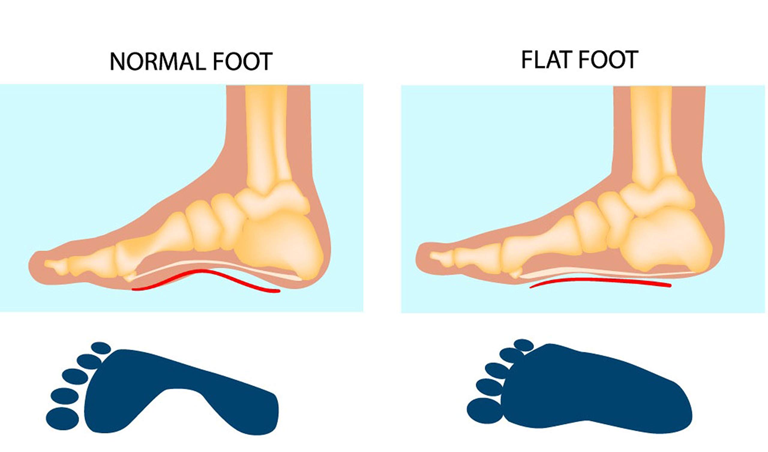 Understanding Flat Feet: Your Guide to Foot Health