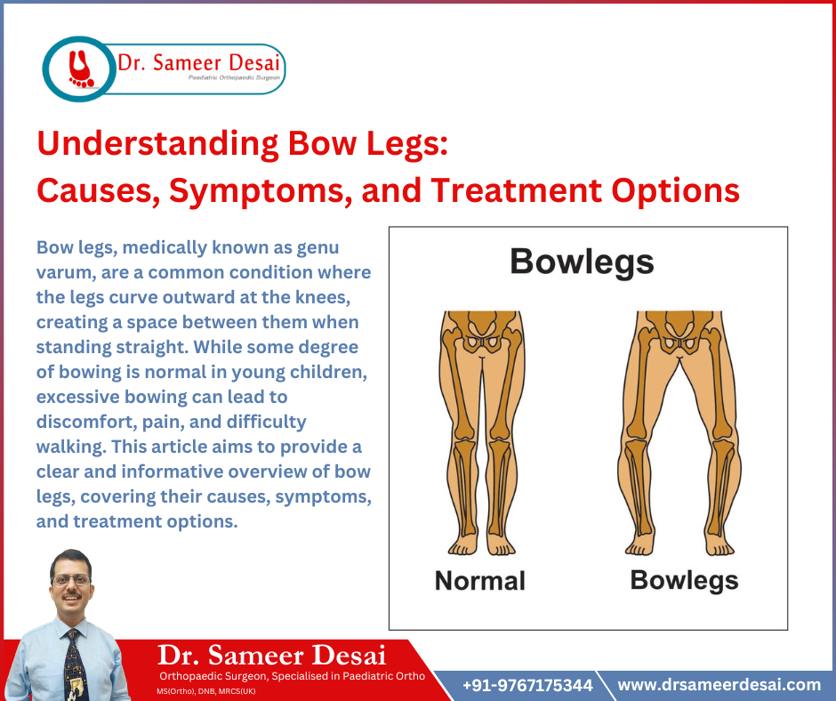 Bow Legs treatment