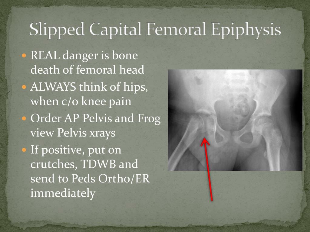 Slipped Capital Femoral Epiphysis treatment