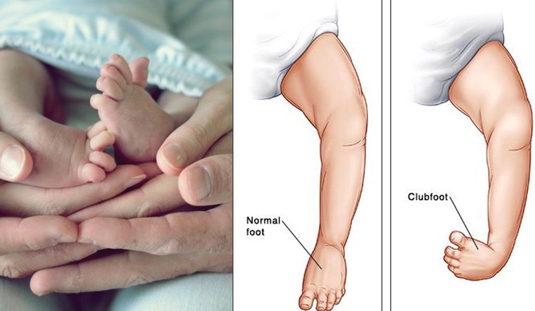 Club foot treatment in Pune