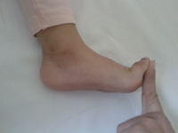 Flat Feet Treatment in Pune