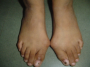 Best Hallux Valgus Treatment in Pune