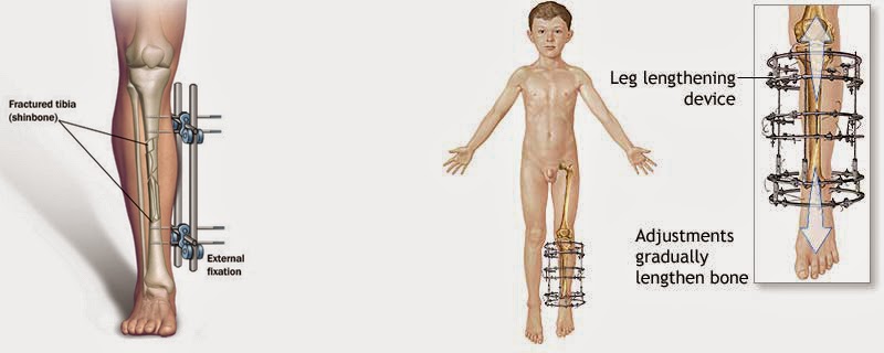 Lengthening Of Bone treatment By expert Pediatric orthopedic surgeon in Pune Dr. Sameer Desai