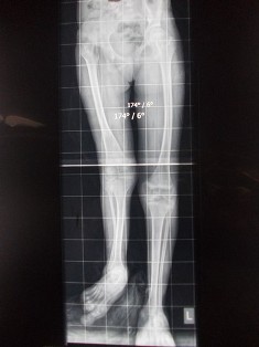 Best Lengthening of Bone Treatment in Pune