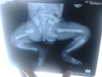 Best Lower Limb Trauma treatment in Pune