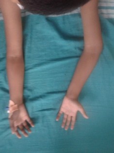 Best Malunited fractures Treatment in Pune