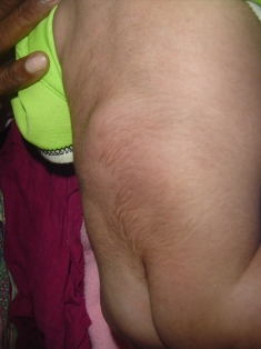 Best Meningo Myelocoele Treatment in Pune