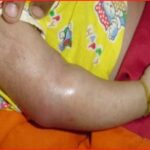 Best Muscular Dystrophy treatment in Pune