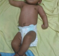 Best Obstretical brachial plexus palsy Treatment in Pune