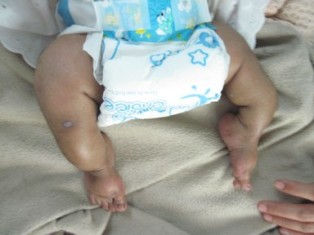 Best Osetogenesis-Imperfect treatment in Pune