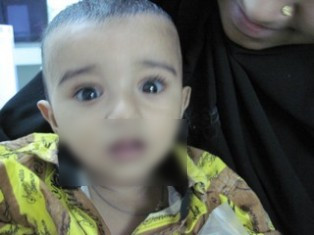 Best Osetogenesis-Imperfect treatment in Pune