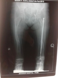 Best Osetogenesis-Imperfect treatment in Pune