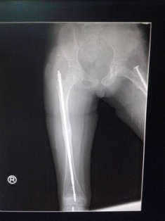 Best Osetogenesis-Imperfect treatment in Pune