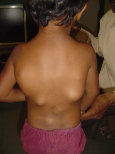 Best Osteochondroma Treatment in Pune