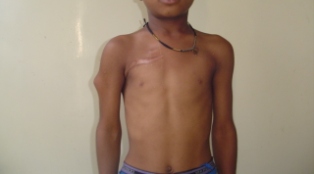 Best Osteochondroma Treatment in Pune