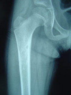 Best Osteoid-osteoma Treatment in Pune