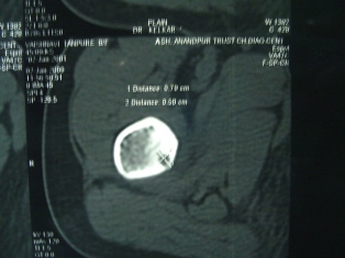 Best Osteoid-osteoma Treatment in Pune