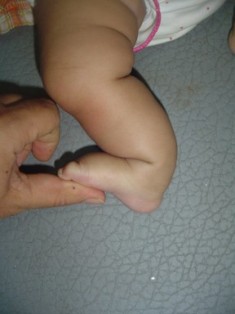 Best Postero Medial Bowing Of Tibia treatment in pune