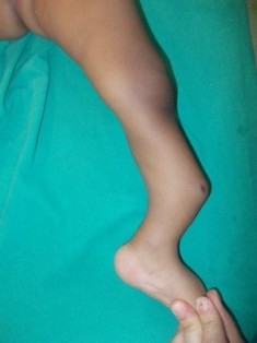 Best Pseudoathrosis of Tibia Treatment in Pune