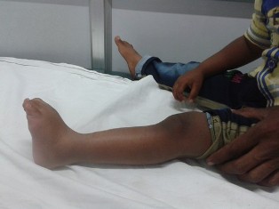 Best Pseudoathrosis of Tibia Treatment in Pune