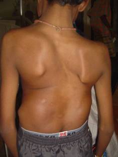 Best Scoliosis And Kyphosis Treatment in Pune