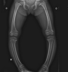 Best Short Stature treatment in Pune