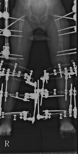 Best Short Stature treatment in Pune