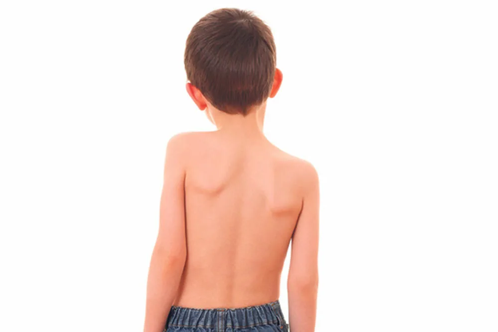 Sprengel Shoulder treatment in Pune
