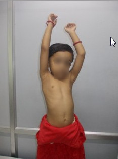 Best Sprengel Shoulder Treatment in Pune