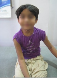 Best Torticollis Treatment in Pune