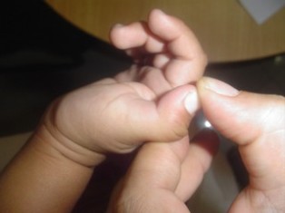 Best Trigger Thumb treatment in Pune