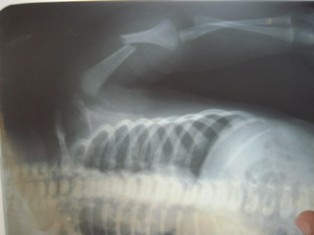 Best Upper Limb Trauma treatment in Pune