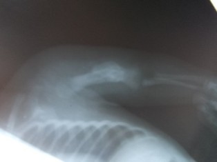 Best Upper Limb Trauma treatment in Pune