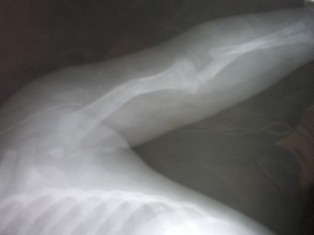 Best Upper Limb Trauma treatment in Pune