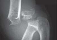 Best Upper Limb Trauma treatment in Pune