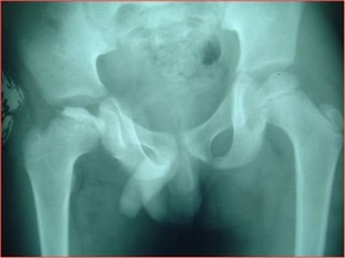 Best Perthes Disease treatment in Pune