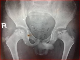 Best Perthes Disease treatment in Pune