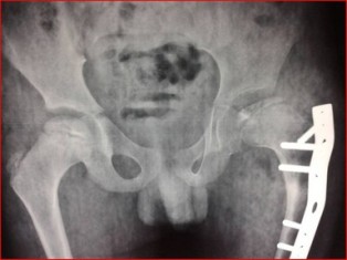 Best Perthes Disease treatment in Pune,