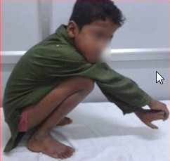 Best Perthes Disease treatment in Pune