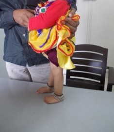 Congenital Dislocation of Knee in Pune