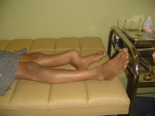 Fibrous-dysplasia Treatment in Pune