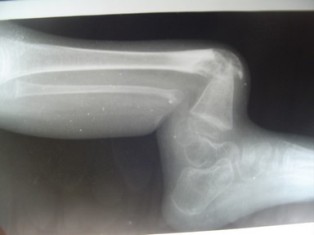 Best Fibrous-dysplasia Treatment in Pune