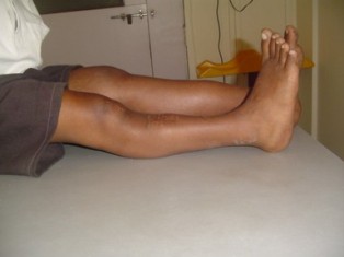 Best Fibrous-dysplasia Treatment in Pune