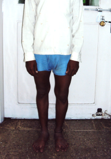 Best Knock Knee Treatment In Pune