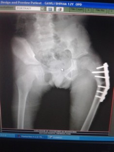 Best Scissoring Treatment In Pune