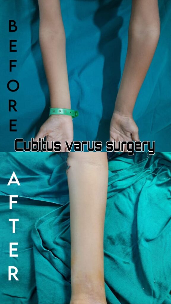 Best Cubitusvarus treatment in pune