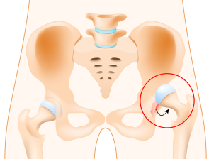 Best dislocation-of-hip Treatment in Pune