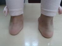 Best flat- feet treatment in Pune